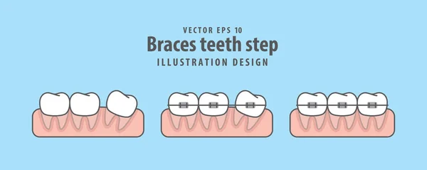 Frenos dientes paso ilustración vector sobre fondo azul. Dental — Vector de stock