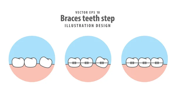 Braces teeth step in circle illustration vector on white backgro — Stock Vector