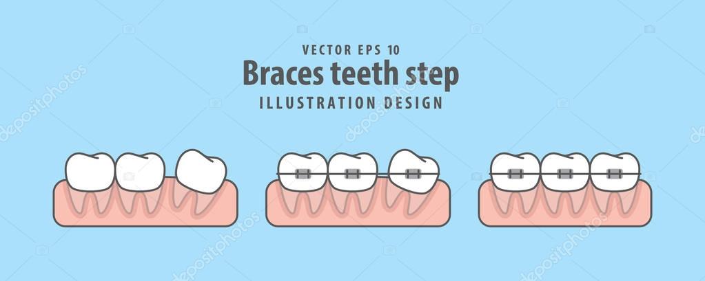 Braces teeth step illustration vector on blue background. Dental concept.