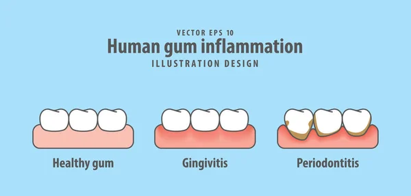 Vettore di illustrazione dell'infiammazione gengivale umana su sfondo blu. D — Vettoriale Stock