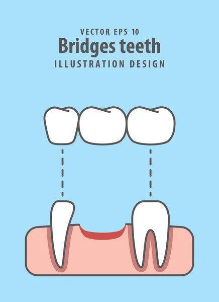 Puentes vector ilustración dientes sobre fondo azul. Contra dental — Vector de stock