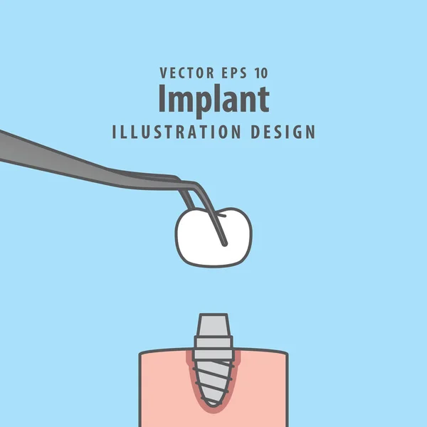 Implantátum illusztráció vektor a kék háttér. Fogászati koncepció. — Stock Vector