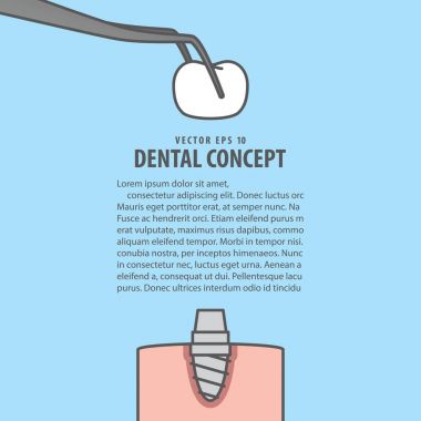 Düzen Implant karikatür tarzı bilgi ya da kitap illüstrasyon vecto için