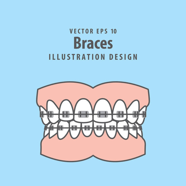 Braces teeth(full) illustration vector on blue background. Denta