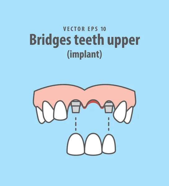 Broar tänder övre implantat () illustration vektor på blå bakgr — Stock vektor