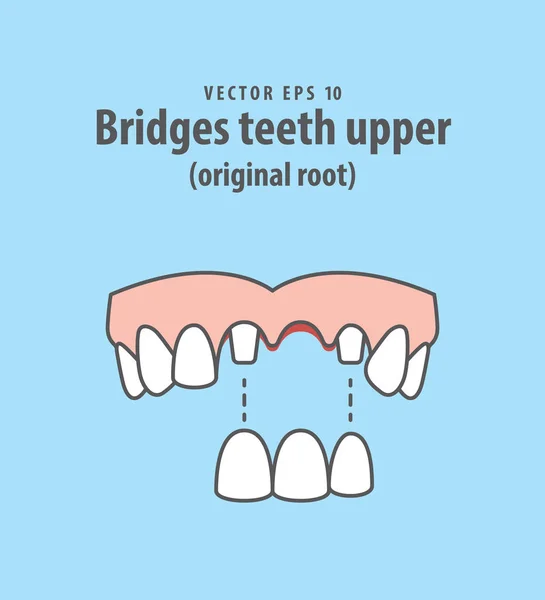 Broar tänder övre (ursprungliga root) illustration vektor på blå — Stock vektor