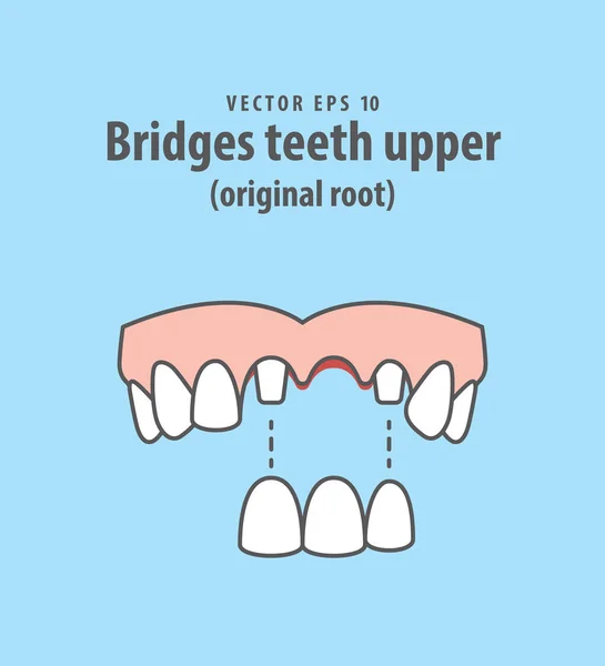 Ponts dents supérieur (racine originale) vecteur d'illustration sur bleu — Image vectorielle