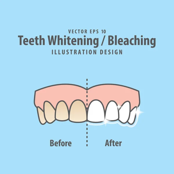 Porównanie górnych zębów Wybielanie wybielanie, przed i po ilustr — Wektor stockowy