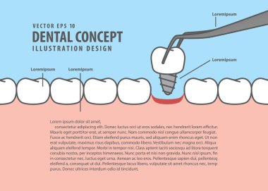 Düzen Implant diş stil için bilgi ya da kitap illüstrasyon karikatür