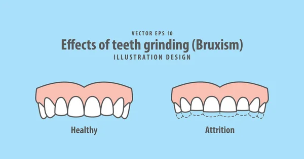 Dişlerini (bruksizm) illüstrasyon vektör mavi etkileri — Stok Vektör