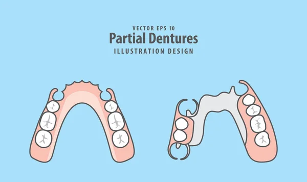 Częściowe protezy wektor na niebieskim tle. Dentystyczne — Wektor stockowy