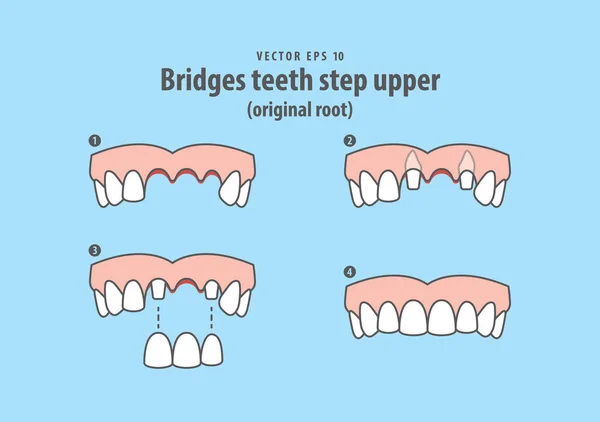 Ponti denti passo superiore (radice originale) vettore illustrazione su — Vettoriale Stock