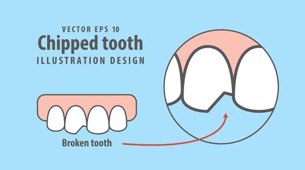 Vetor de ilustração de dente lascado em fundo azul. Condição dentária —  Vetores de Stock