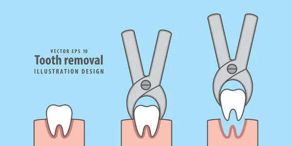 Diente eliminación ilustración vector sobre fondo azul. Contra dental — Vector de stock