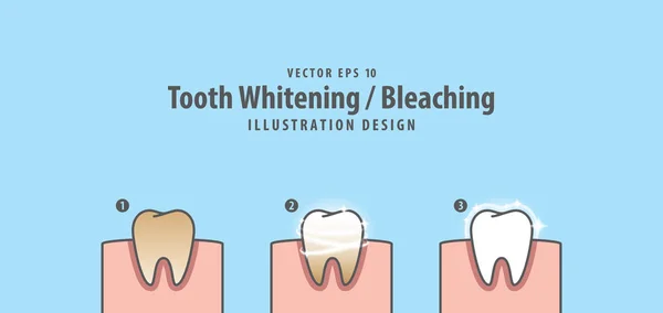 Steg av enstaka tand Whitening-blekning och mänskliga tuggummi nedanstående — Stock vektor