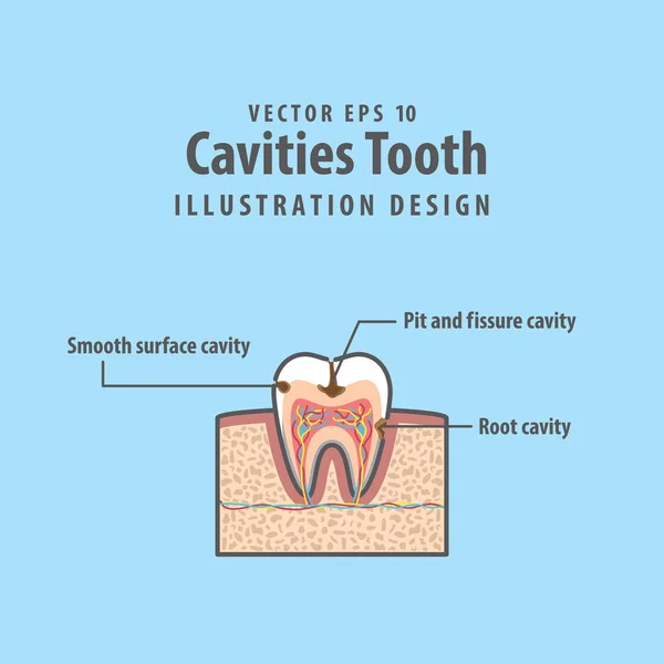 Cavitys tand dwarsdoorsnede structuur binnen de tand diagram en c — Stockvector