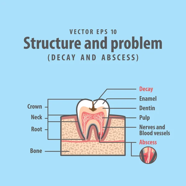 Struttura a sezione trasversale di decomposizione e ascesso all'interno del diagramma dei denti a — Vettoriale Stock