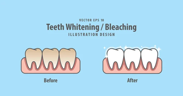 Jämföra tandblekning Whitening före och efter bild — Stock vektor