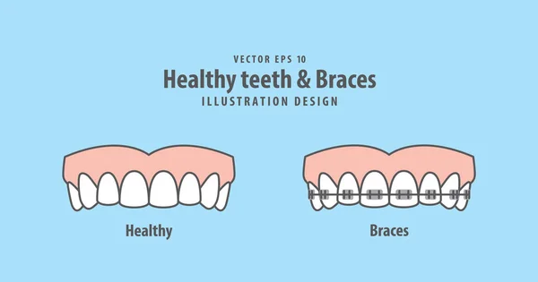 Zdrowe zęby & wektor nawiasy klamrowe na niebieskim tle. D — Wektor stockowy