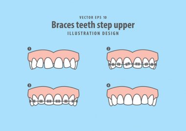 Diş telleri diş adım üst illüstrasyon vektör mavi zemin üzerine. 