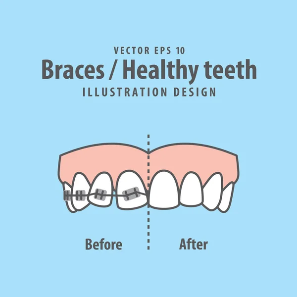 Braces-Dentes saudáveis vetor de ilustração em fundo azul. Den... —  Vetores de Stock