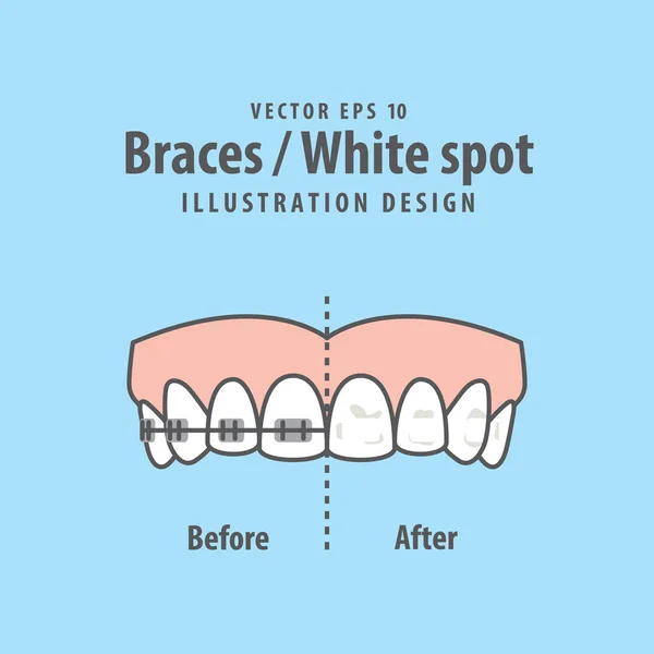 Braces-Vecteur d'illustration tache blanche sur fond bleu. Soins dentaires — Image vectorielle