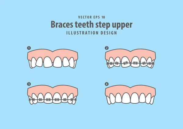 Braces dientes paso vector ilustración superior sobre fondo azul . — Vector de stock