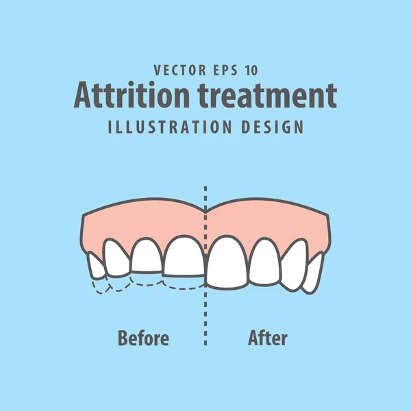 Bruxism Stok Vektor Ilustrasi Bruxism Bebas Royalti Depositphotos