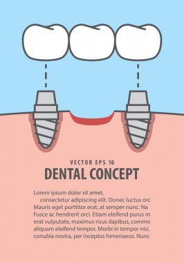 Mavi backgro illüstrasyon vektör düzen köprüler diş implant
