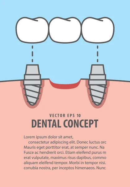 Layout Ponti denti impianto illustrazione vettore su dorso blu — Vettoriale Stock