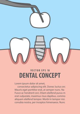 Düzen Implant diş illüstrasyon vektör mavi zemin üzerine. Den