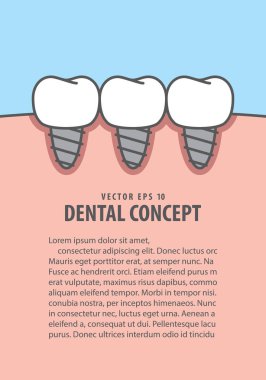 Düzen Implant diş illüstrasyon vektör mavi zemin üzerine. Den