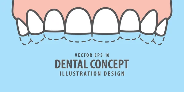 Bannière Dents d'attrition supérieure (Bruxisme) illustration vectorielle sur bl — Image vectorielle
