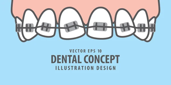 Banner Upper Braces teeth illustration vector on blue background — Stock Vector