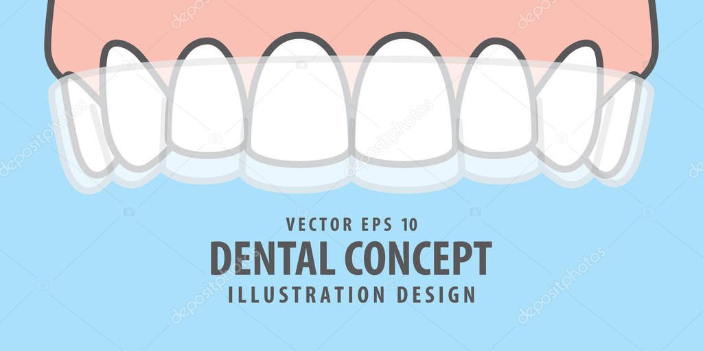 Banner Upper Essix retainer illustration vector on blue backgrou