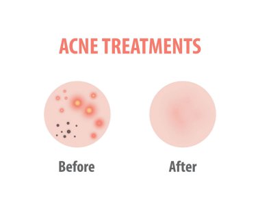 Akne tedavisi beyaz arka plan üzerinde illüstrasyon vektör diyagramı,