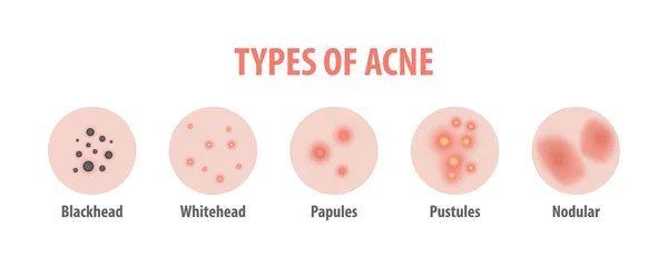 Tipi di acne diagramma illustrazione vettore su sfondo bianco, B — Vettoriale Stock