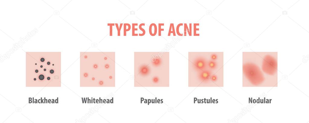 Types of acne diagram illustration vector on white background, B