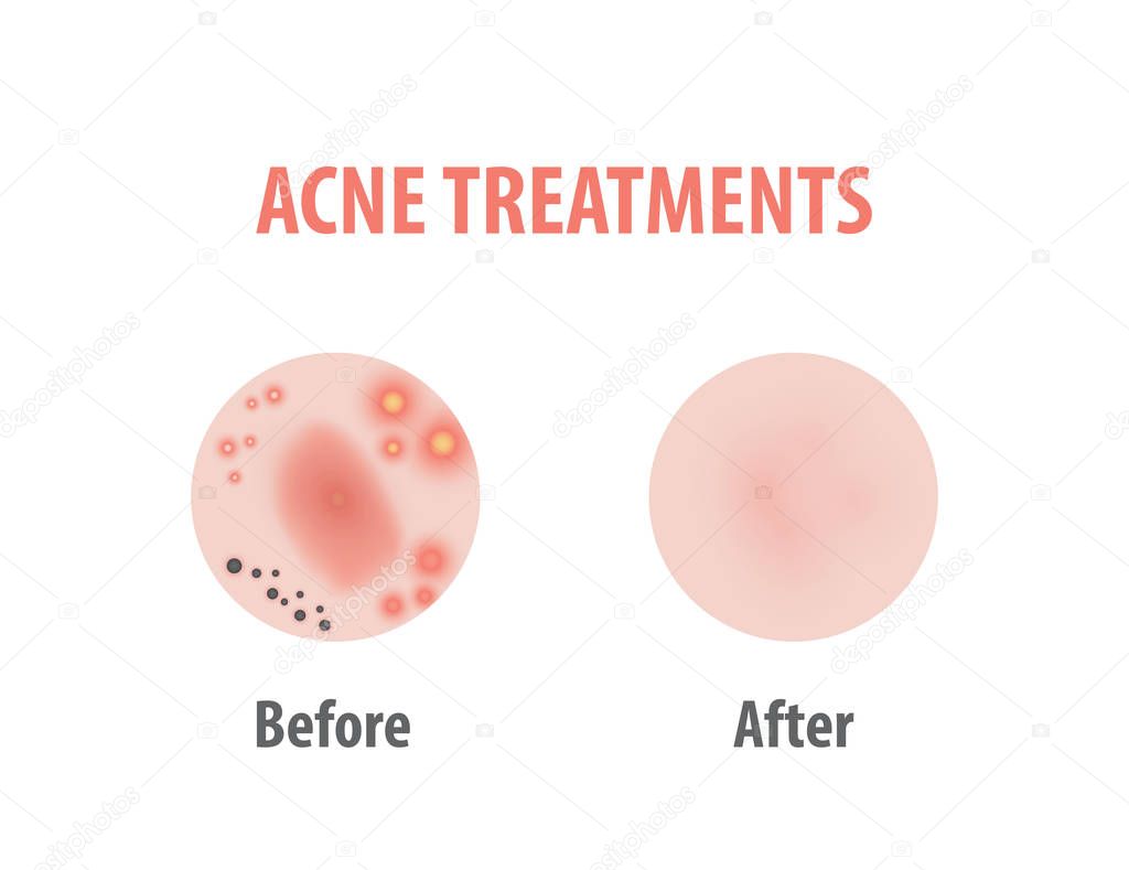 Acne treatments diagram illustration vector on white background,