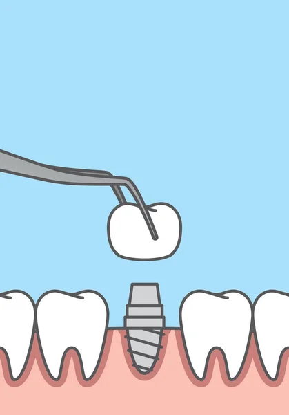 Banner en blanco Implantar dientes vector de ilustración en el fondo azul — Vector de stock