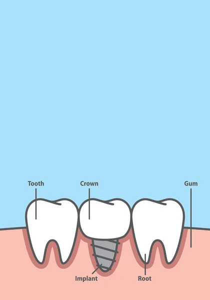 Boş pankart. Gerçek diş çerçevesi stil arasına diş nakli. — Stok Vektör