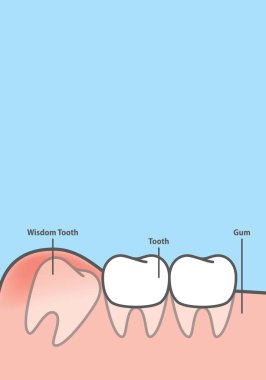 Blank banner wisdom Impacted tooth inside under inflammation gum