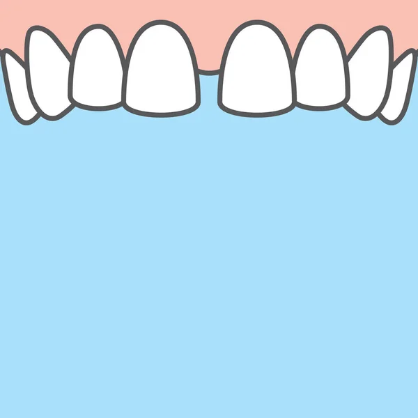 Banner en blanco Diastema superior dientes ilustración vector en ba azul — Archivo Imágenes Vectoriales