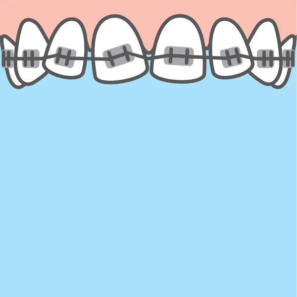 Blank banner Upper Braces teeth illustration vector on blue back — Stock Vector