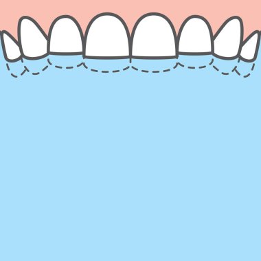 Boş pankart Üst Yıkımı (Bruxism) diş örnekleme vektörü
