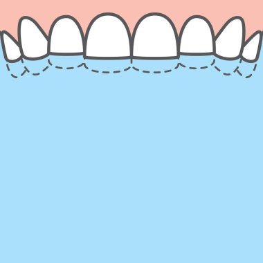 Boş pankart Üst Yıkımı (Bruxism) diş örnekleme vektörü