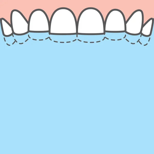 Banner en blanco Desgaste superior (bruxismo) dientes ilustración vector — Archivo Imágenes Vectoriales