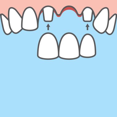 Blank banner Bridges teeth upper (original root) illustration ve clipart