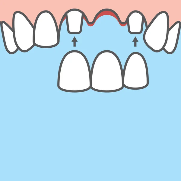 Blank banner Bridges teeth upper (original root) illustration ve — Stock Vector