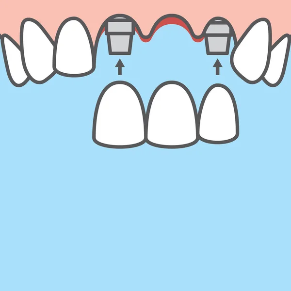 Banner en blanco Puentes dientes superior (implante) ilustración vector o — Archivo Imágenes Vectoriales